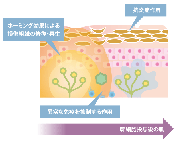 幹細胞によるアトピー性皮膚炎の治療